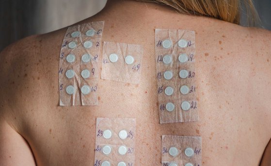 Allergien Nacken und Rücken einer Frau mit Allergietest beklebt.